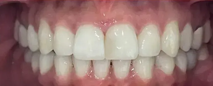Second smile after treatment