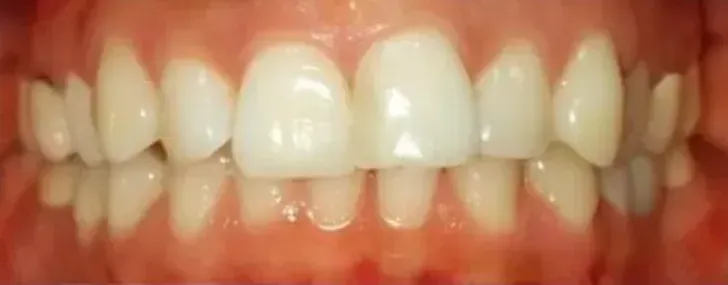 Second smile before treatment
