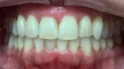 Smile after Invisalign treatment