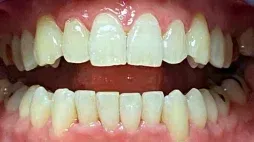 Smile with alignment issues after Invisalign treatment