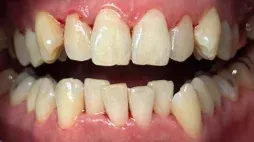 Smile with alignment issues before Invisalign treatment