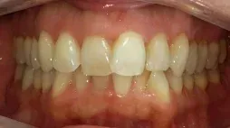 Smile before Invisalign treatment