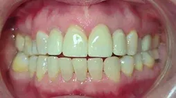 Smile with an open bite after Invisalign treatment