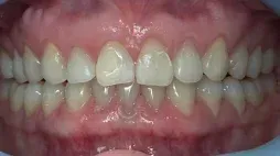 Smile with spacing after Invisalign treatment