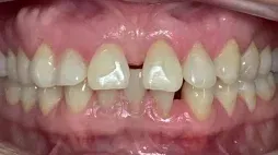 Smile with spacing before Invisalign treatment