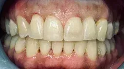 img transformation crowded teeth after