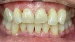 img transformation crowded teeth before